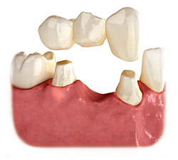 Pont dentaire